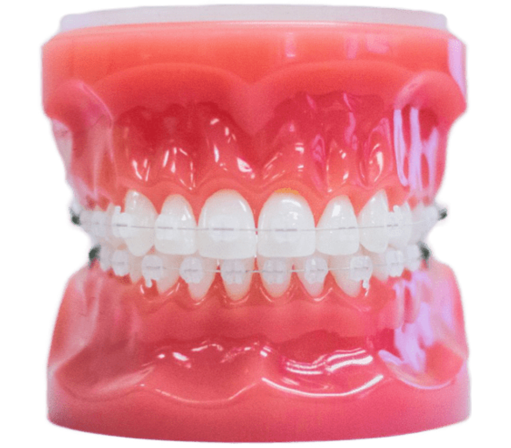 invisalign aligners on plastic model
